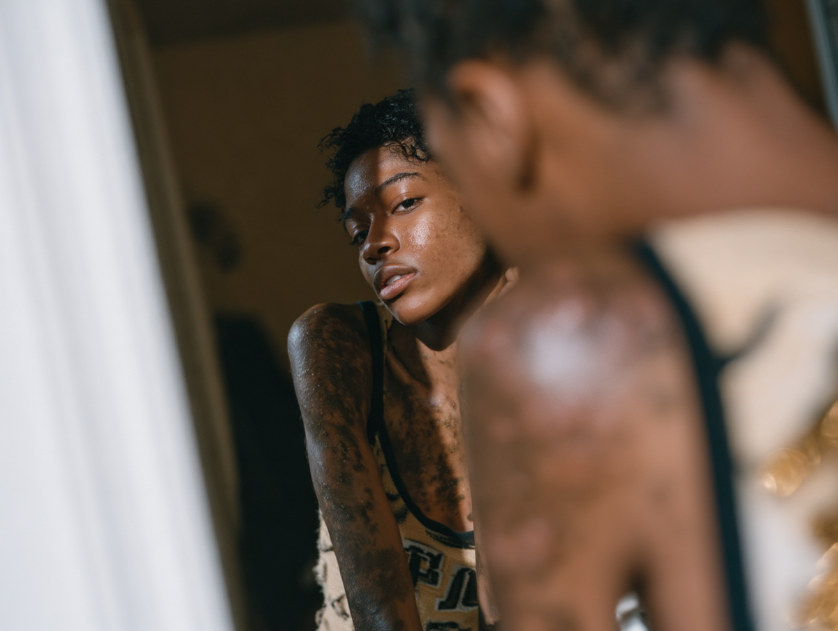 A young Black woman looks at herself in a mirror, with visible plaques and dark skin patches across her arms, chest and shoulders.